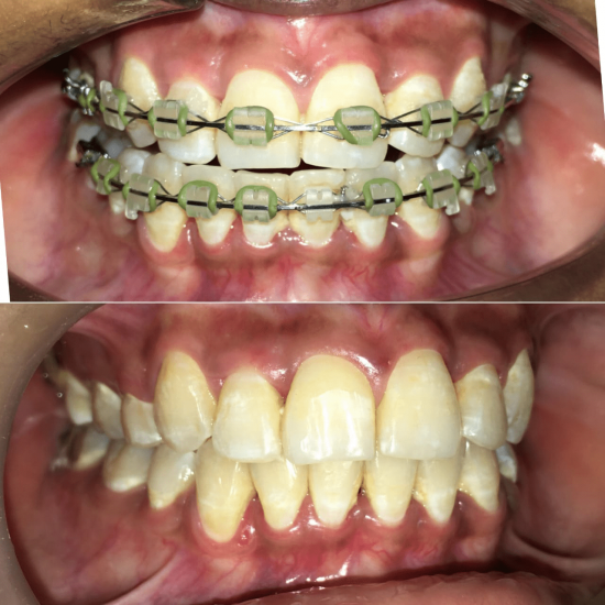 Tooth Colour Filling