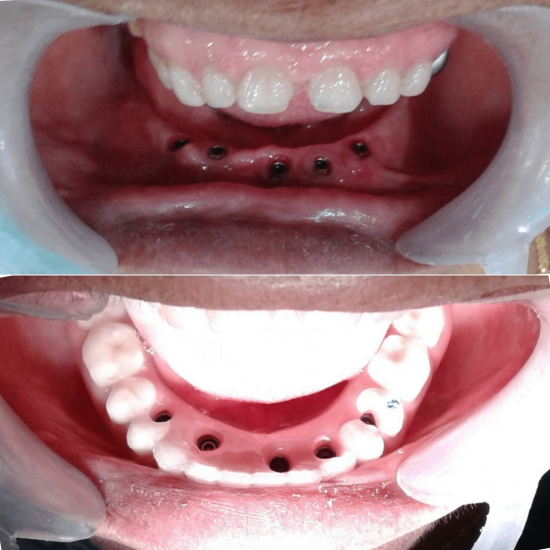 Tooth Colour Filling