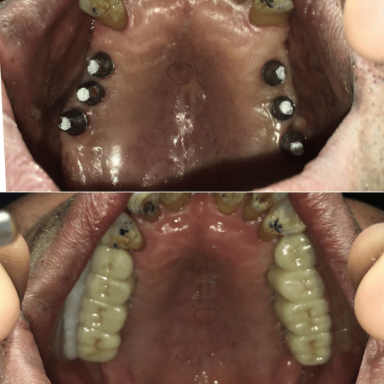 Tooth Colour Filling