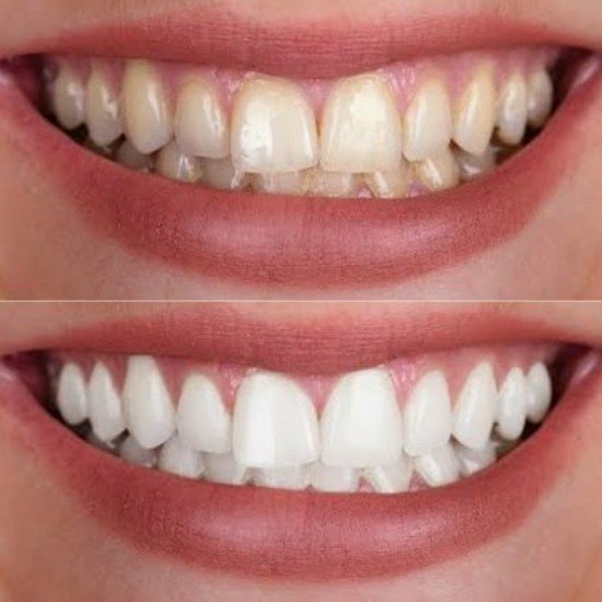 Tooth Colour Filling