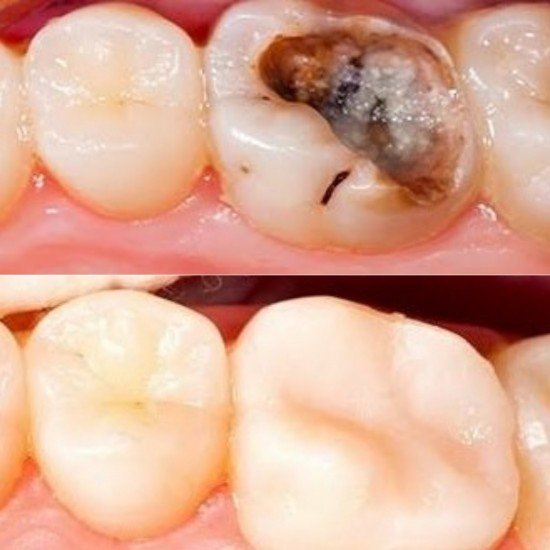 Tooth Colour Filling