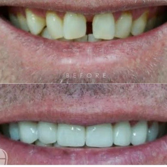 Tooth Colour Filling