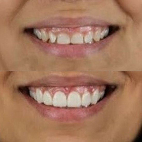 Tooth Colour Filling