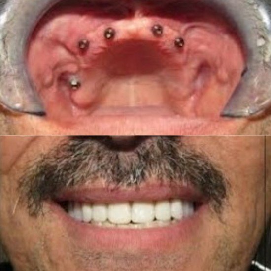 Tooth Colour Filling