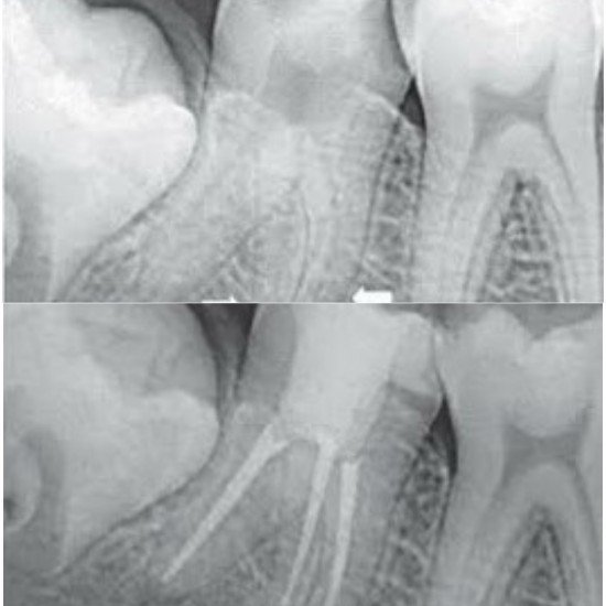 Tooth Colour Filling