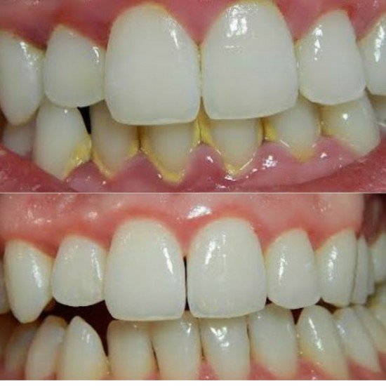 Tooth Colour Filling