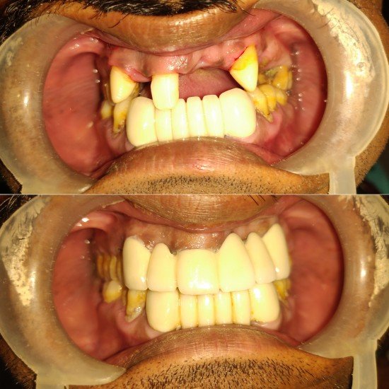 Tooth Colour Filling