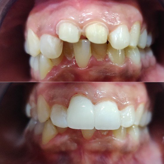 Tooth Colour Filling